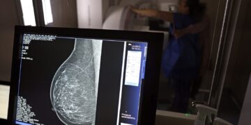 AGU processa médico que apontou mamografia como causadora de câncer