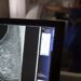 AGU processa médico que apontou mamografia como causadora de câncer