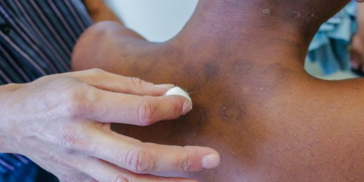 IA criada por brasileiros avalia risco de agravamento da hanseníase