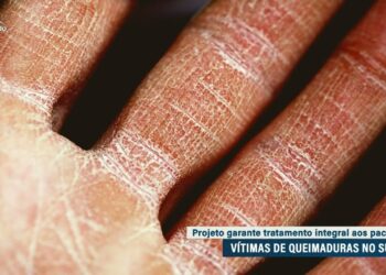 Garantia de tratamento integral para vítimas de queimaduras volta pra Câmara — Senado Notícias