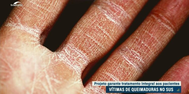 Garantia de tratamento integral para vítimas de queimaduras volta pra Câmara — Senado Notícias