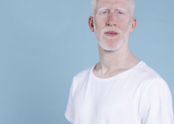 Sancionada lei que cria política de proteção a pessoas com albinismo