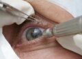 Cirurgia que altera cor do olho tem uso restrito para pessoas cegas