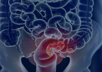 Estudo projeta aumento de 36% em mortes por câncer colorretal até 2040