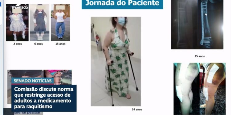 Debatedores na CDH defendem ampliar uso de medicamento contra raquitismo — Senado Notícias