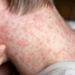Sarampo: entenda sinais e sintomas, riscos e quando se vacinar